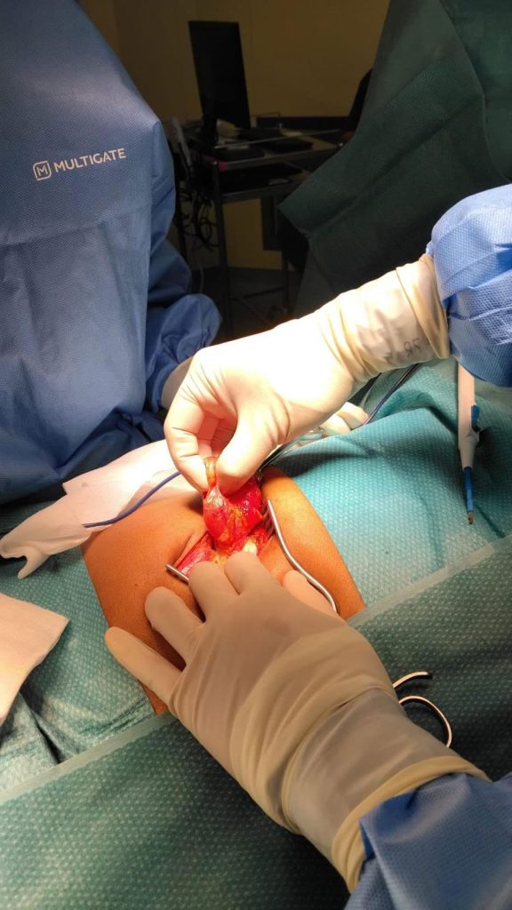 Biological hernia mesh used during surgical repair of abdominal hernia